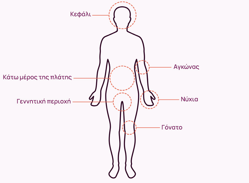 Εκεί όπου η ψωρίαση γίνεται ορατή.